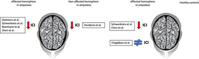 Intracortical Inhibition in the Affected Hemisphere in Limb Amputation